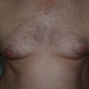 CHEST BEFORE MPX SMART LIPO